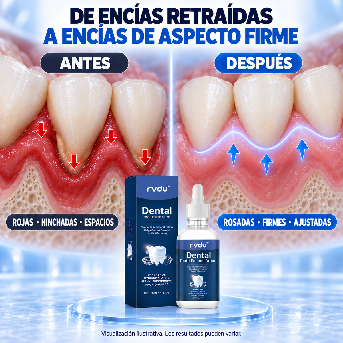 Rvdu Líquido Periodontal Para Encías Dañadas Sensibles Y Retraídas 60 Ml Limpieza De Manchas En Dientes Cuidado De La Línea Gingival